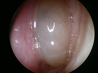 in-office-nasal-endoscopy-1