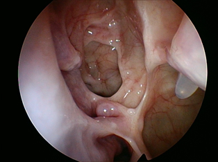 in-office-nasal-endoscopy-2