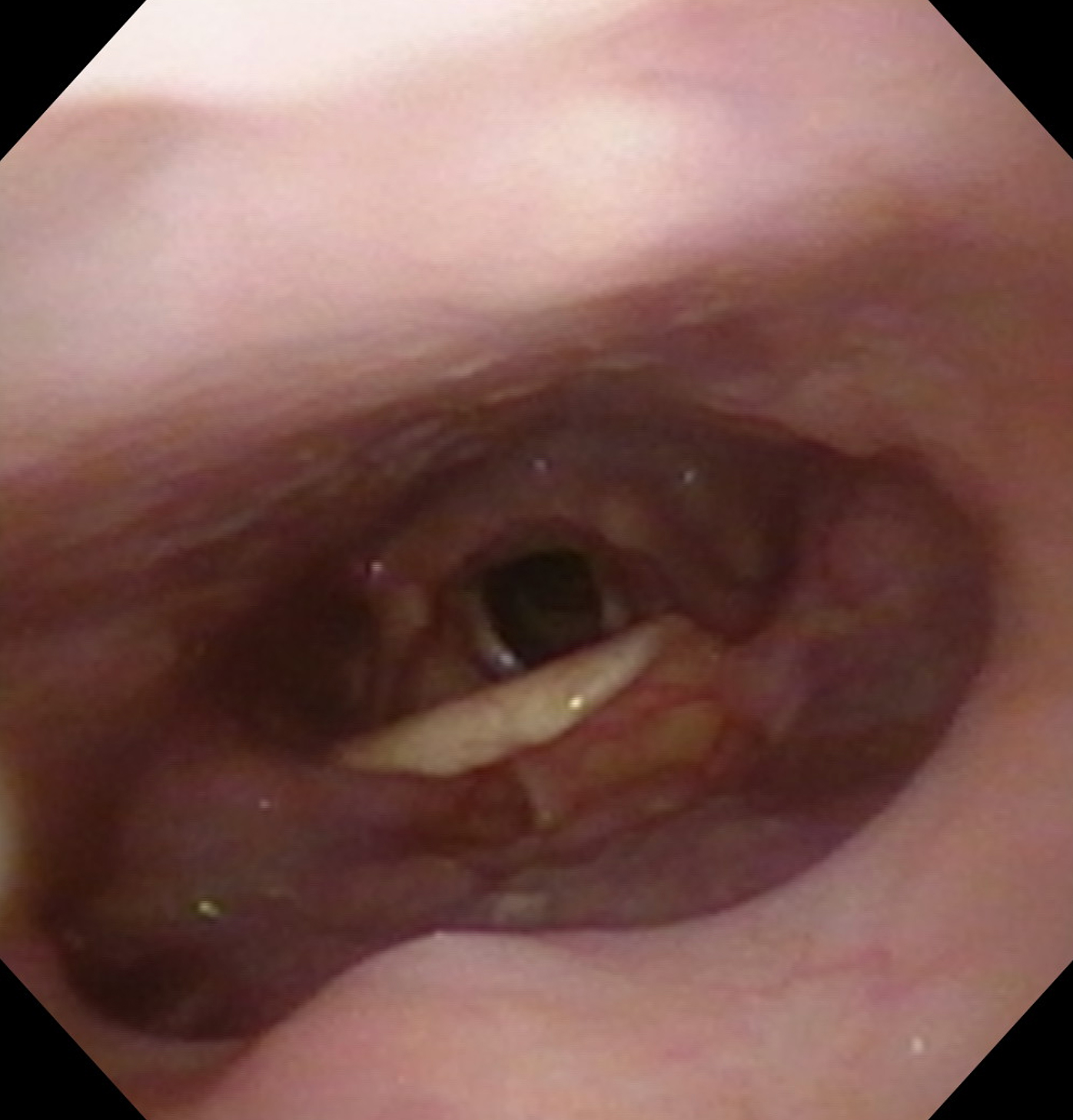 in-office-upper-airway-endoscopy-after