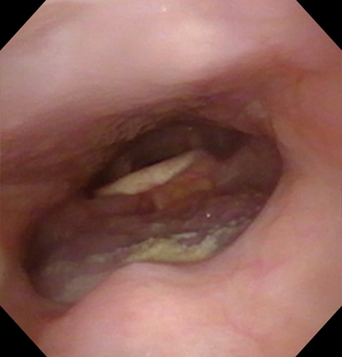 in-office-upper-airway-endoscopy-before