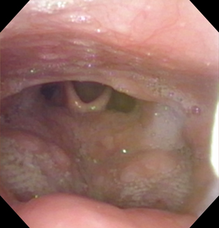 palatal-surgery-after