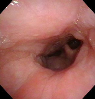 palatal-surgery-before