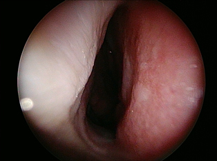 septoplasty-after