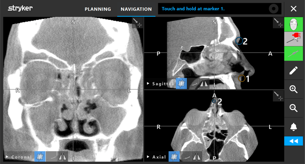 office based sinonasal surgery